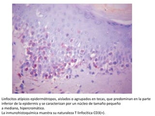 Linfocitos atípicos epidermótropos, aislados o agrupados en tecas, que predominan en la parte
inferior de la epidermis y se caracterizan por un núcleo de tamaño pequeño
a mediano, hipercromático.
La inmunohistoquímica muestra su naturaleza T linfocítica CD3(+).
 