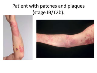 Patient with patches and plaques
(stage IB/T2b).
 