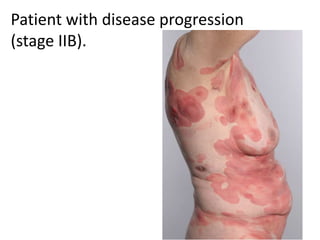 Patient with disease progression
(stage IIB).
 