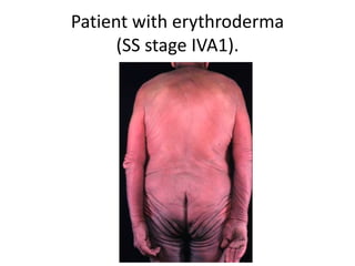Patient with erythroderma
(SS stage IVA1).
 