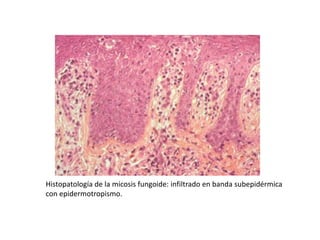 Histopatología de la micosis fungoide: infiltrado en banda subepidérmica
con epidermotropismo.
 