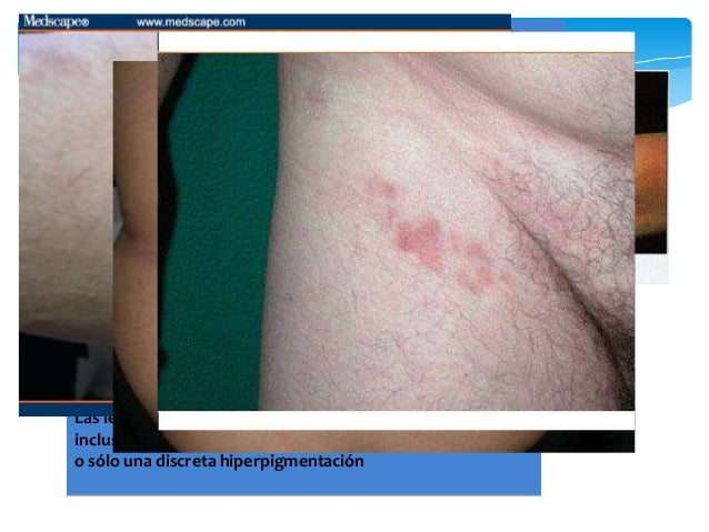 que es la enfermedad micosis fungoide que es la enfermedad micosis fungoide