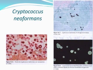 Cryptococcus neoformans  