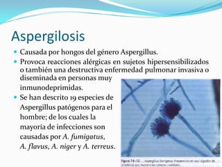 Aspergilosis 
 
Causada por hongos del género Aspergillus. 
 
Provoca reacciones alérgicas en sujetos hipersensibilizados o también una destructiva enfermedad pulmonar invasiva o diseminada en personas muy 
inmunodeprimidas. 
 
Se han descrito 19 especies de 
Aspergillus patógenos para el 
hombre; de los cuales la 
mayoría de infecciones son 
causadas por A. fumigatus, 
A. flavus, A. niger y A. terreus.  