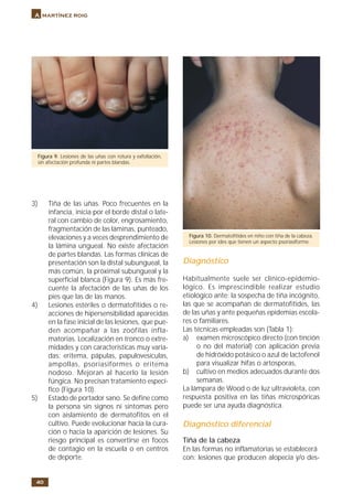 40
A martínez roig
3) Tiña de las uñas. Poco frecuentes en la
infancia, inicia por el borde distal o late-
ral con cambio de color, engrosamiento,
fragmentación de las láminas, punteado,
elevaciones y a veces desprendimiento de
la lámina ungueal. No existe afectación
de partes blandas. Las formas clínicas de
presentación son la distal subungueal, la
más común, la proximal subungueal y la
superficial blanca (Figura 9). Es más fre-
cuente la afectación de las uñas de los
pies que las de las manos.
4) Lesiones estériles o dermatofítides o re-
acciones de hipersensibilidad aparecidas
en la fase inicial de las lesiones, que pue-
den acompañar a las zoófilas infla-
matorias. Localización en tronco o extre-
midades y con características muy varia-
das: eritema, pápulas, papulovesículas,
ampollas, psoriasiformes o eritema
nodoso. Mejoran al hacerlo la lesión
fúngica. No precisan tratamiento especí-
fico (Figura 10).
5) Estado de portador sano. Se define como
la persona sin signos ni síntomas pero
con aislamiento de dermatofitos en el
cultivo. Puede evolucionar hacia la cura-
ción o hacia la aparición de lesiones. Su
riesgo principal es convertirse en focos
de contagio en la escuela o en centros
de deporte.
Diagnóstico
Habitualmente suele ser clínico-epidemio-
lógico. Es imprescindible realizar estudio
etiológico ante: la sospecha de tiña incógnito,
las que se acompañan de dermatofítides, las
de las uñas y ante pequeñas epidemias escola-
res o familiares.
Las técnicas empleadas son (Tabla 1):
a) examen microscópico directo (con tinción
o no del material) con aplicación previa
de hidróxido potásico o azul de lactofenol
para visualizar hifas o artosporas,
b) cultivo en medios adecuados durante dos
semanas.
La lámpara de Wood o de luz ultravioleta, con
respuesta positiva en las tiñas microspóricas
puede ser una ayuda diagnóstica.
Diagnóstico diferencial
Tiña de la cabeza
En las formas no inflamatorias se establecerá
con: lesiones que producen alopecia y/o des-
Figura 9. Lesiones de las uñas con rotura y exfoliación,
sin afectación profunda ni partes blandas.
Figura 10. Dermatofítides en niño con tiña de la cabeza.
Lesiones por ides que tienen un aspecto psoriasiforme.
 