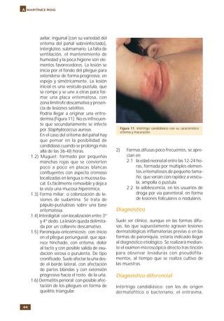 44
A martínez roig
axilar, inguinal (con su variedad del
eritema del pañal sobreinfectado),
interglúteo, submamario. La falta de
ventilación, el mantenimiento de
humedad y la poca higiene son ele-
mentos favorecedores. La lesión se
inicia por el fondo del pliegue para
extenderse de forma progresiva, en
espejo y simétricamente. La lesión
inicial es una vesículo-pústula, que
se rompe y se une a otras para for-
mar una placa eritematosa, con
zona limítrofe descamativa y presen-
cia de lesiones satélites.
Podría llegar a originar una eritro-
dermia (Figura 11). No es infrecuen-
te que secundariamente se infecte
por Staphylococcus aureus.
En el caso del eritema del pañal hay
que pensar en la posibilidad de
candidiasis cuando se prolonga más
allá de las 36-48 horas.
1.2) Muguet: formado por pequeñas
manchas rojas que se convierten
poco a poco en placas blancas
confluyentes con aspecto cremoso
localizadas en lengua o mucosa bu-
cal. Es fácilmente removible y deja a
la vista una mucosa hiperémica.
1.3) Forma miliar: o colonización de le-
siones de sudamina. Se trata de
pápulo-pustulosas sobre una base
eritematosa.
1.4) Interdigital: con localización entre 3º
y 4º dedo. La lesión queda delimita-
da por un collarete descamativo.
1.5) Paroniquia-onicomicosis: con inicio
en el pliegue periungueal, que apa-
rece hinchado, con eritema, dolor
al tacto y con posible salida de exu-
dación serosa o purulenta. De tipo
cronificado. Suele afectar la uña des-
de el borde lateral, con afectación
de partes blandas y con extensión
progresiva hacía el resto de la uña.
1.6) Dermatitis perioral: con posible afec-
tación de los pliegues en forma de
queilitis triangular.
2) Formas difusas poco frecuentes, se apre-
cian en
2.1 la edad neonatal entre las 12-24 ho-
ras, formada por múltiples elemen-
tos eritematosos de pequeño tama-
ño, que varían con rapidez a vesícu-
la, ampolla o pústula.
2.2 la adolescencia, en los usuarios de
droga por vía parenteral, en forma
de lesiones foliculares o nodulares.
Diagnóstico
Suele ser clínico, aunque en las formas difu-
sas, las que supuestamente agravan lesiones
dermatológicas inflamatorias previas o en las
formas de paroniquia, estaría indicado llegar
al diagnóstico etiológico. Se realizará median-
te el examen microscópico directo tras tinción
para observar levaduras con pseudofila-
mentos, al tiempo que se realiza cultivo de
las muestras.
Diagnóstico diferencial
Intértrigo candidiásico: con los de origen
dermatofítico o bacteriano, el eritrasma,
Figura 11. Intértrigo candidiásico con su característico
eritema y maceración.
 