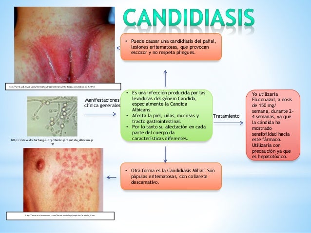 Exantema De Pañal Por Candidiasis