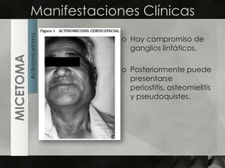 Manifestaciones ClínicasHay compromiso de ganglios linfáticos.Posteriormente puede presentarse periostitis, osteomielitis y pseudoquistes.ActinomicetomaMICETOMA