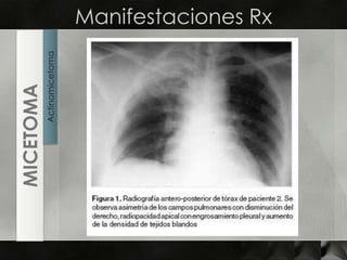 Manifestaciones RxActinomicetomaMICETOMA