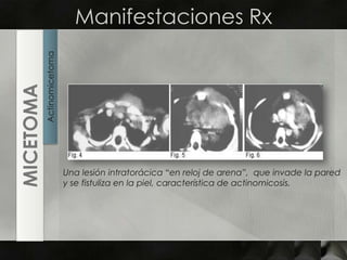 Manifestaciones RxActinomicetomaMICETOMAUna lesión intratorácica “en reloj de arena”,  que invade la pared y se fistuliza en la piel, característica de actinomicosis. 