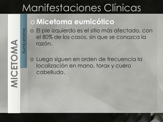 Manifestaciones ClínicasMicetomaeumicóticoEl pie izquierdo es el sitio más afectado, con el 80% de los casos, sin que se conozca la razón.Luego siguen en orden de frecuencia la localización en mano, torax y cuero cabelludo.EumicetomaMICETOMA