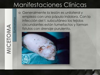 Manifestaciones ClínicasGeneralmente la lesión es unilateral y empieza con una pápula indolora. Con la infección del t. subcutáneo los tejidos circundantes están tumefactos y forman fístulas con drenaje purulento.EumicetomaMICETOMA