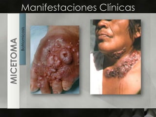 Manifestaciones ClínicasBotriomicosisMICETOMA