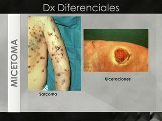 Dx DiferencialesMICETOMAUlceracionesSarcoma