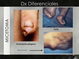 Dx DiferencialesGotaMICETOMAGranuloma piógenoMicetoma