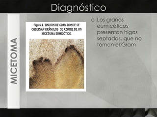 DiagnósticoLos granos eumicóticos presentan higas septadas, que no toman el GramMICETOMA