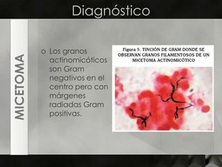 DiagnósticoLos granos actinomicóticos son Gram negativos en el centro pero con márgenes radiadas Gram positivas.MICETOMA