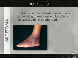 DefiniciónSe diferencia por sus fístulas, que drenan un contenido granuloso (esclerotia, gránulos de azufre) y por el edema local.MICETOMA