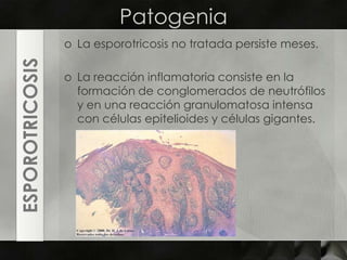 PatogeniaLa esporotricosis no tratada persiste meses. Lareacción inflamatoria consiste en la formación de conglomerados de neutrófilos y en una reacción granulomatosa intensa con células epitelioides y células gigantes.ESPOROTRICOSIS