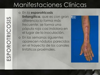 Manifestaciones ClínicasEn la esporotricosislinfangítica, que es con gran diferencia la forma más frecuente, se forma una pápula roja casi indolora en el lugar de la inoculación. En las semanas siguientes aparecen nódulos parecidos en el trayecto de los canales linfáticos proximales.ESPOROTRICOSIS