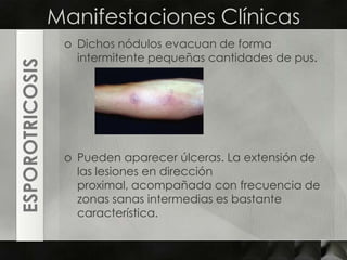 Manifestaciones ClínicasDichos nódulos evacuan de forma intermitente pequeñas cantidades de pus. Pueden aparecer úlceras. La extensión de las lesiones en dirección proximal, acompañada con frecuencia de zonas sanas intermedias es bastante característica.ESPOROTRICOSIS