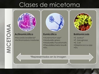 Clases de micetomaMICETOMA*Representados en la imagen