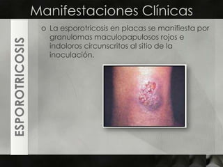 Manifestaciones ClínicasLa esporotricosis en placas se manifiesta por granulomasmaculopapulososrojos e indoloros circunscritos al sitio de la inoculación.ESPOROTRICOSIS