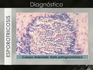 DiagnósticoESPOROTRICOSISCuerpo Asteroide: Dato patognomónico