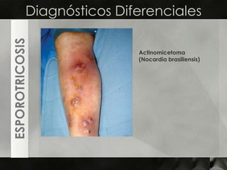 Diagnósticos DiferencialesActinomicetoma(Nocardiabrasiliensis)ESPOROTRICOSIS