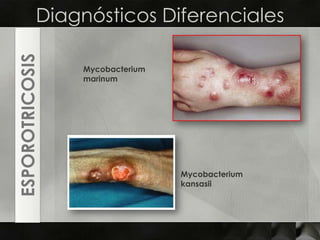 Diagnósticos DiferencialesMycobacteriummarinumESPOROTRICOSISMycobacteriumkansasii
