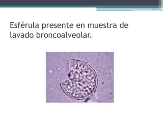 Esférula presente en muestra de
lavado broncoalveolar.
 