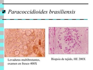 Paracoccidioides brasiliensis 
Levaduras multibrotantes, 
examen en fresco 400X 
Biopsia de tejido, HE 200X 
