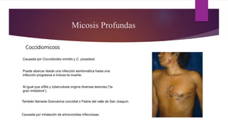 Coccidiomicosis
Micosis Profundas
Causada por Coccidioides immitis y C. posadasii.
Causada por inhalación de artroconidias infecciosas.
Puede abarcar desde una infección asintomática hasta una
infección progresiva e incluso la muerte.
Al igual que sífilis y tuberculosis origina diversas lesiones (“la
gran imitadora”).
También llamada Granuloma coccidial o Fiebre del valle de San Joaquín.
 