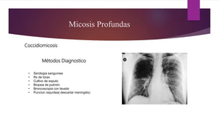 Micosis Profundas
Coccidiomicosis
Métodos Diagnostico
• Serologia sanguínea
• Rx de torax
• Cultivo de esputo
• Biopsia de pulmón
• Broncoscopia con lavado
• Puncion raquídea( descartar meningitis)
 