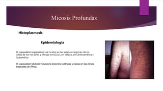 H. capsulatum capsulatum: se localiza en las extensas regiones de los
valles de los ríos Ohio y Misisipi en EE.UU., en México, en Centroamérica y
Sudamérica
H. capsulatum duboisii: Ocasiona lesiones cutáneas y óseas en las zonas
tropicales de África.
Epidemiologia
Micosis Profundas
Histoplasmosis
 