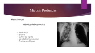 Métodos de Diagnostico
Micosis Profundas
Histoplasmosis
• Rx de Torax
• Biopsia
• Cultivo de esputo
• Lavado Bronquioalveolar
• Pruebas serológicas.
 