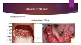 Micosis Profundas
Paracoccidioimicosis
La infección pulmonar suele ser asintomática en 95% de los casos.
Forma pulmonar sintomática aguda:
• Fiebre
• Escalosfrios
• Tos
• Disnea
• Infiltrados pulmonares
Forma pulmonar crónica:
• Tos con expectoración purulenta y hemorrágica (hemoptisis)
• Insuficiencia respiratoria
• Dolor torácico
• Fiebres que pueden ser similares a las de la Tuberculosis pulmonar
Forma diseminada:
• Fiebre
• Cefalea
• lesiones cutaneas
• Ulceras bucales y de la mucosa faríngea con
perforación del paladar
• Sudoracion
Manifestaciones Clínicas
 