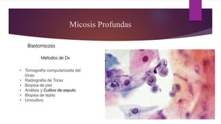 Micosis Profundas
Blastomicosis
• Tomografía computarizada del
tórax
• Radiografia de Torax
• Biopsia de piel
• Análisis y Cultivo de esputo
• Biopsia de tejido
• Urocultivo
Metodos de Dx
 