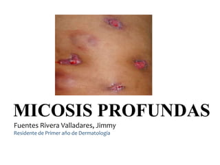 MICOSIS PROFUNDAS
Fuentes Rivera Valladares, Jimmy
Residente de Primer año de Dermatología
 