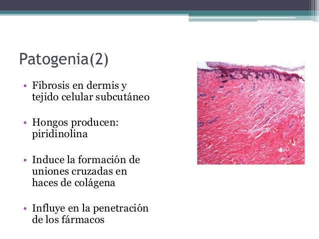 Como revelan la psoriasis