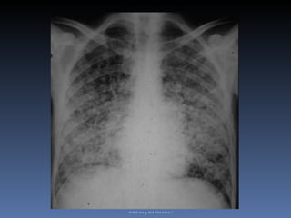 HCM - Neumonolgia - Micosis Pulmonar  