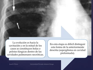 La evolución es hacia la
cavitación y en la mitad de los
casos se constituyen bolas o
pelotas fúngicas dentro de las
cavidades pulmonares necróticas.

En esta etapa es difícil distinguir
esta forma de la anteriormente
descrita (aspergiloma en cavidad
preformada).

 