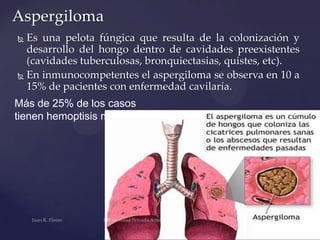 Aspergiloma
Es una pelota fúngica que resulta de la colonización y
desarrollo del hongo dentro de cavidades preexistentes
(cavidades tuberculosas, bronquiectasias, quistes, etc).
 En inmunocompetentes el aspergiloma se observa en 10 a
15% de pacientes con enfermedad cavilaría.


Más de 25% de los casos
tienen hemoptisis masiva.

 