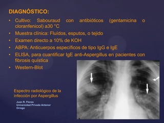 DIAGNÓSTICO:
• Cultivo: Sabouraud con antibióticos (gentamicina o
cloranfenicol) a30 °C
• Muestra clínica: Fluídos, esputos, o tejido
• Examen directo a 10% de KOH
• ABPA: Anticuerpos específicos de tipo IgG e IgE
• ELISA, para cuantificar IgE anti-Aspergillus en pacientes con
fibrosis quística
• Western-Blot

Espectro radiológico de la
infección por Aspergillus
Juan R. Flores
Universidad Privada Antenor
Orrego

 