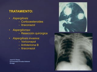 TRATAMIENTO:
• Aspergilosis
- Corticoesteroides
- Itraconazol
• Aspergilomas:
- Resección quirúrgica
• Aspergilosis invasiva:
- Voriconazol
- Anfotericina B
- Itraconazol

Juan R. Flores
Universidad Privada Antenor
Orrego

 