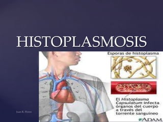 HISTOPLASMOSIS

 