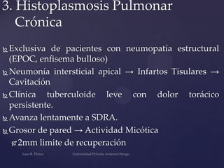 3. Histoplasmosis Pulmonar
Crónica
Exclusiva de pacientes con neumopatía estructural
(EPOC, enfisema bulloso)
 Neumonía intersticial apical → Infartos Tisulares →
Cavitación
 Clínica
tuberculoide leve con dolor torácico
persistente.
 Avanza lentamente a SDRA.
 Grosor de pared → Actividad Micótica
 2mm limite de recuperación


 