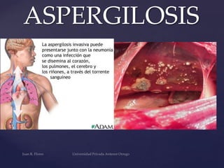 ASPERGILOSIS

 