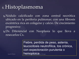 4.

Histoplasmoma

Nódulo calcificado con zona central necrótica
ubicado en la periferia pulmonar; con una fibrosis
excéntrica rica en colágeno y calcio. De crecimiento
progresivo
 Dx Diferencial con Neoplasia lo que lleva a
resecarlos Cx.


Fiebre, perdida de peso, astenia,
leucocitosis neutrofílica, tos crónica,
con expectoración purulenta o
hemoptoica

 