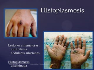 Histoplasmosis

Lesiones eritematosas
infiltrativas,
nodulares, ulceradas
Histoplasmosis
diseminada

 